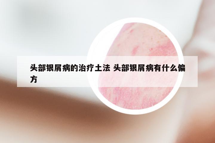 头部银屑病的治疗土法 头部银屑病有什么偏方