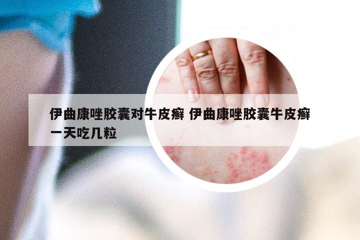 伊曲康唑胶囊对牛皮癣 伊曲康唑胶囊牛皮癣一天吃几粒