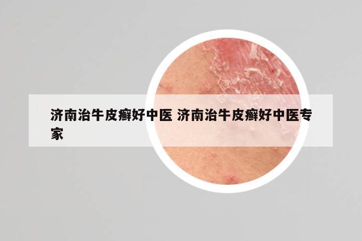 济南治牛皮癣好中医 济南治牛皮癣好中医专家