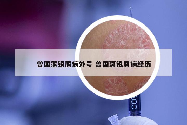 曾国藩银屑病外号 曾国藩银屑病经历
