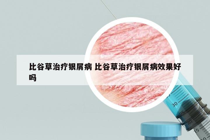比谷草治疗银屑病 比谷草治疗银屑病效果好吗