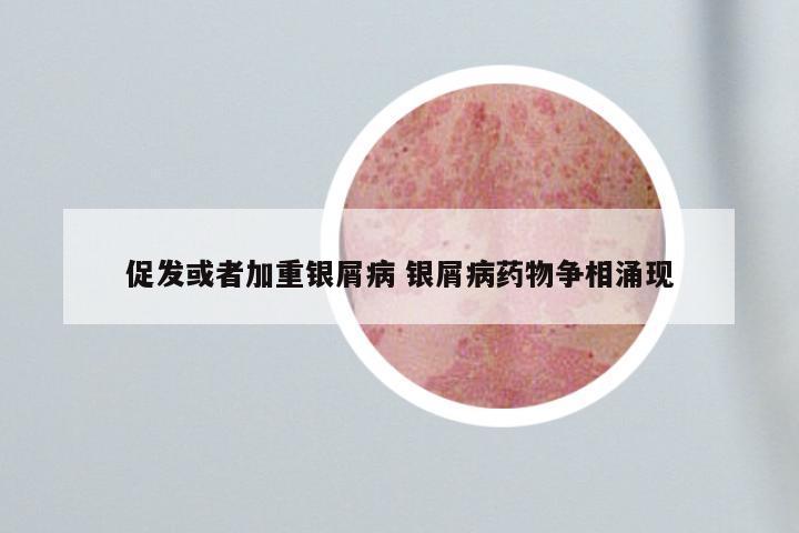 促发或者加重银屑病 银屑病药物争相涌现