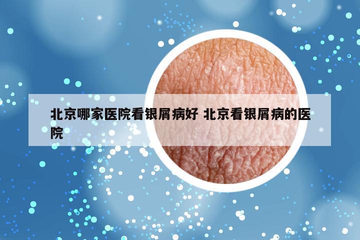 北京哪家医院看银屑病好 北京看银屑病的医院
