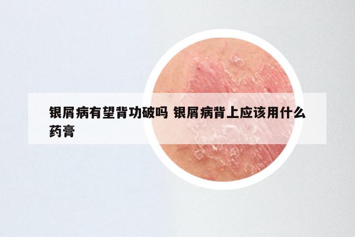 银屑病有望背功破吗 银屑病背上应该用什么药膏