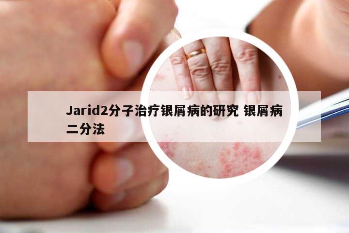 Jarid2分子治疗银屑病的研究 银屑病二分法