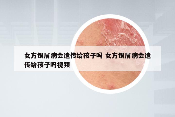 女方银屑病会遗传给孩子吗 女方银屑病会遗传给孩子吗视频