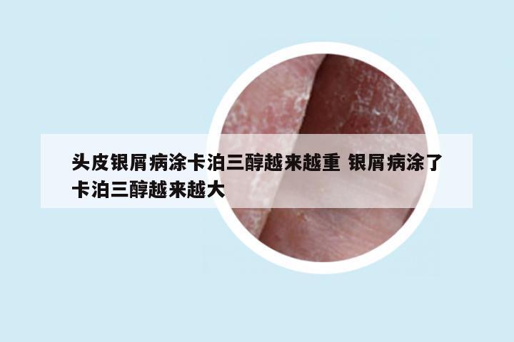 头皮银屑病涂卡泊三醇越来越重 银屑病涂了卡泊三醇越来越大