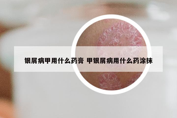 银屑病甲用什么药膏 甲银屑病用什么药涂抹