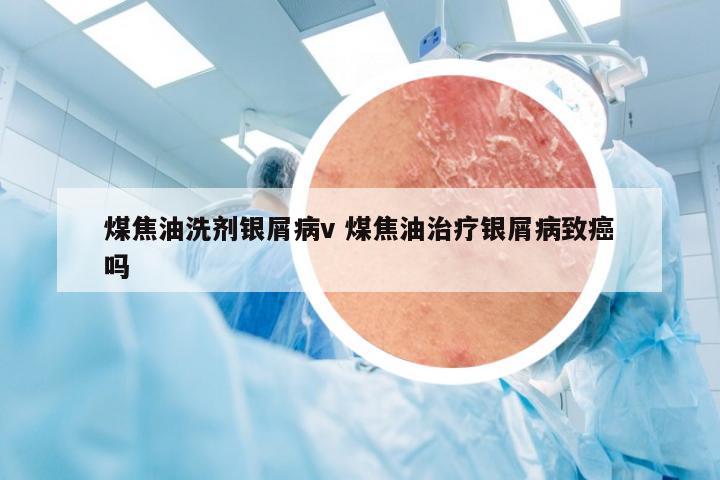 煤焦油洗剂银屑病v 煤焦油治疗银屑病致癌吗