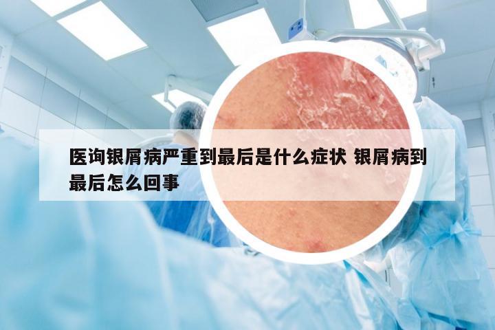 医询银屑病严重到最后是什么症状 银屑病到最后怎么回事