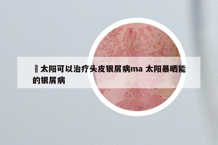 嗮太阳可以治疗头皮银屑病ma 太阳暴晒能的银屑病