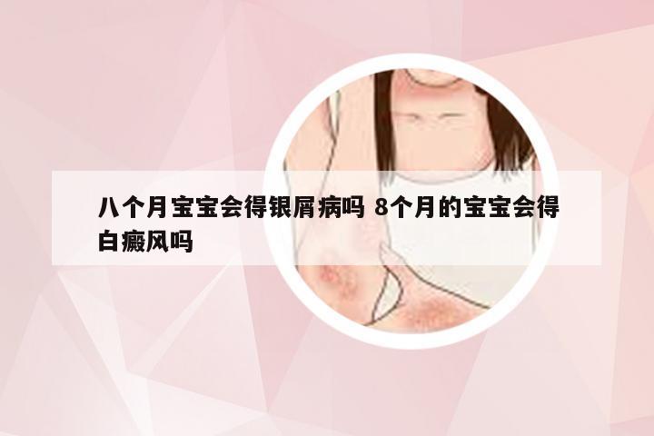 八个月宝宝会得银屑病吗 8个月的宝宝会得白癜风吗