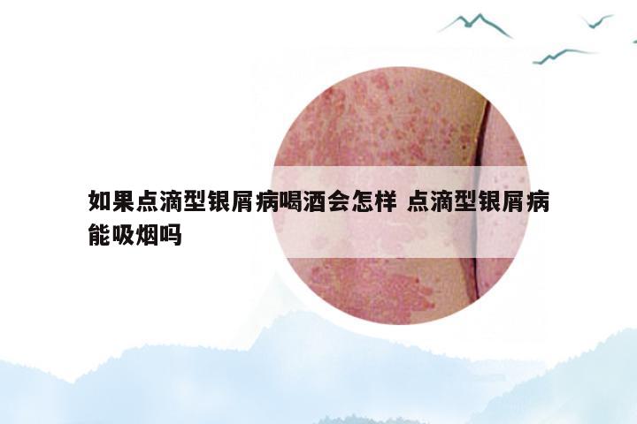 如果点滴型银屑病喝酒会怎样 点滴型银屑病能吸烟吗