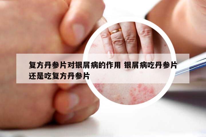 复方丹参片对银屑病的作用 银屑病吃丹参片还是吃复方丹参片