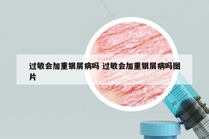 过敏会加重银屑病吗 过敏会加重银屑病吗图片
