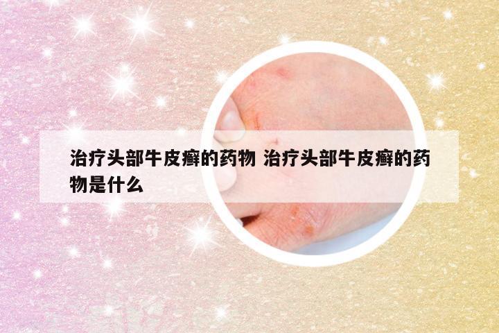 治疗头部牛皮癣的药物 治疗头部牛皮癣的药物是什么