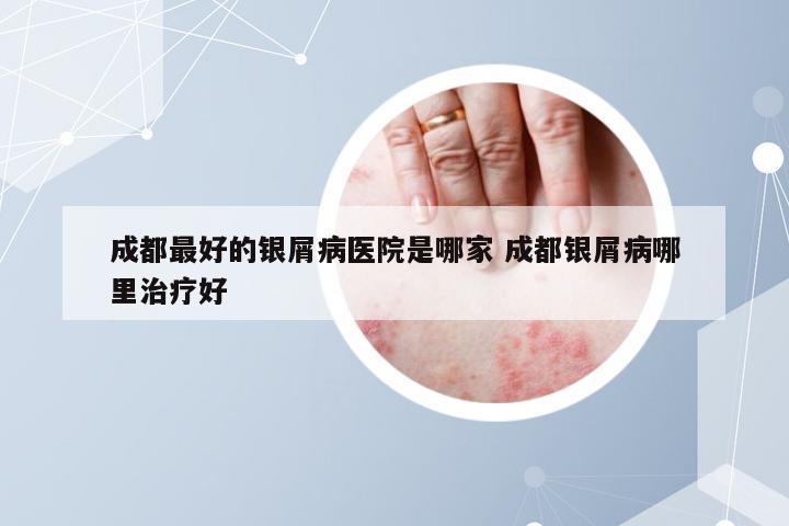 成都最好的银屑病医院是哪家 成都银屑病哪里治疗好