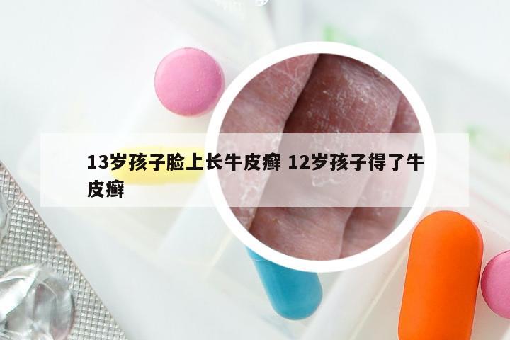 13岁孩子脸上长牛皮癣 12岁孩子得了牛皮癣