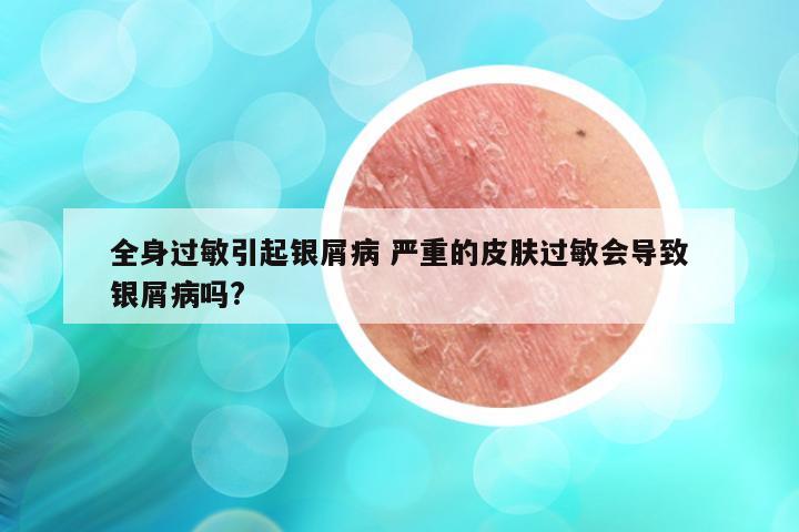 全身过敏引起银屑病 严重的皮肤过敏会导致银屑病吗?