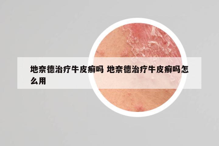 地奈德治疗牛皮癣吗 地奈德治疗牛皮癣吗怎么用