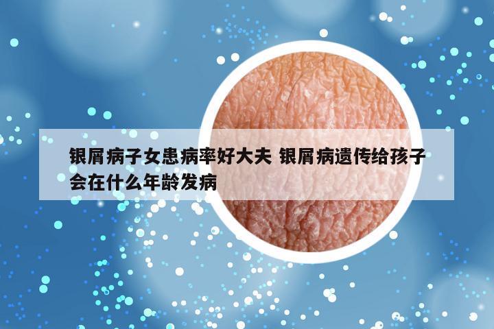 银屑病子女患病率好大夫 银屑病遗传给孩子会在什么年龄发病