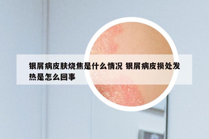 银屑病皮肤烧焦是什么情况 银屑病皮损处发热是怎么回事