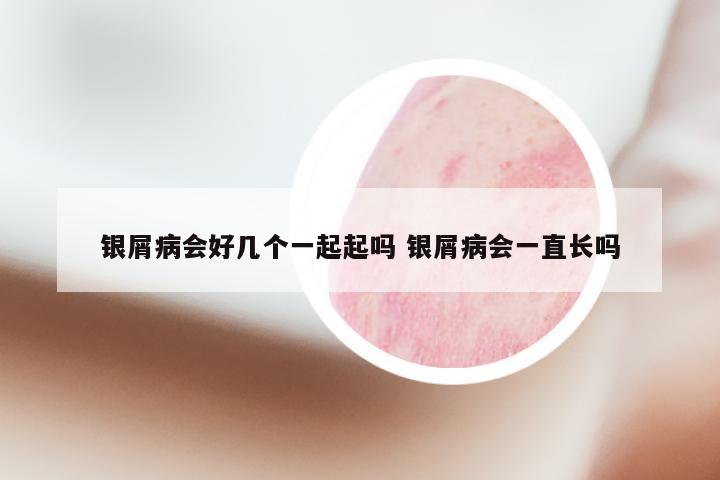 银屑病会好几个一起起吗 银屑病会一直长吗
