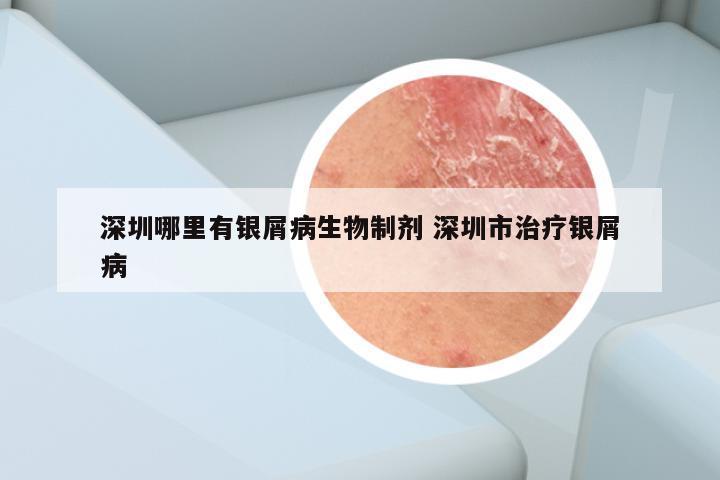 深圳哪里有银屑病生物制剂 深圳市治疗银屑病