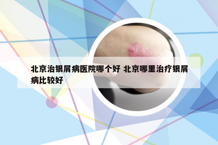 北京治银屑病医院哪个好 北京哪里治疗银屑病比较好