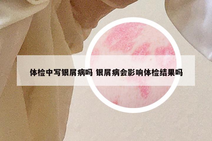 体检中写银屑病吗 银屑病会影响体检结果吗