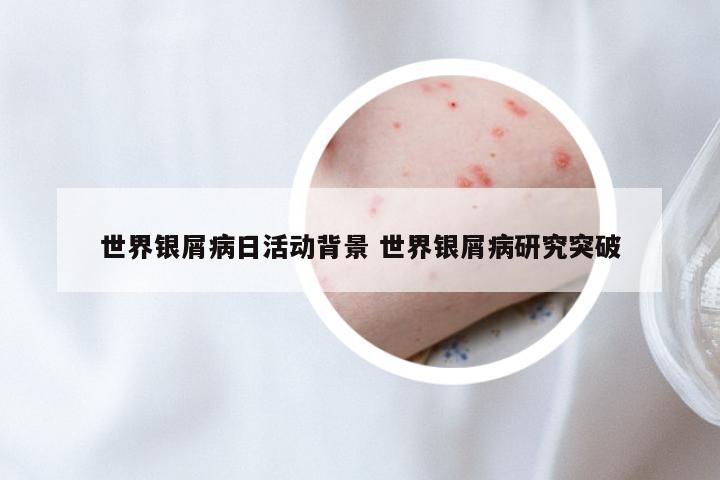 世界银屑病日活动背景 世界银屑病研究突破