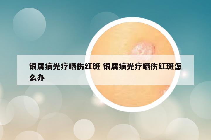 银屑病光疗晒伤红斑 银屑病光疗晒伤红斑怎么办