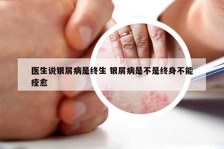 医生说银屑病是终生 银屑病是不是终身不能痊愈