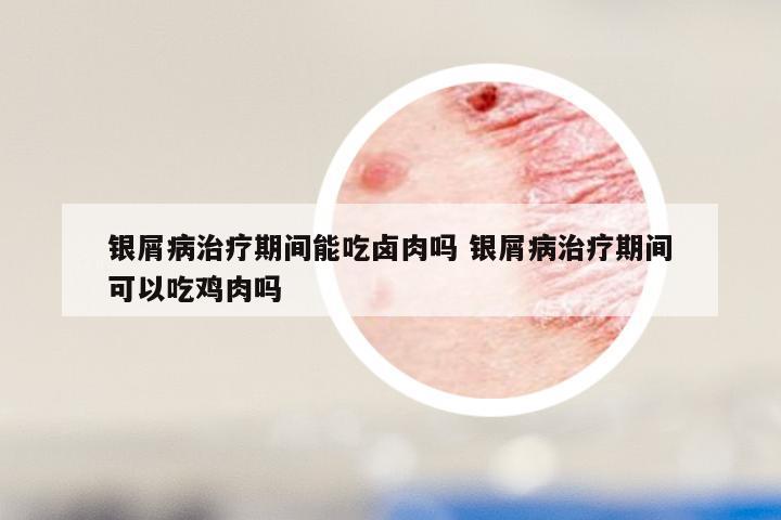 银屑病治疗期间能吃卤肉吗 银屑病治疗期间可以吃鸡肉吗