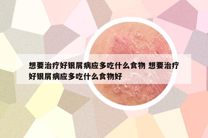 想要治疗好银屑病应多吃什么食物 想要治疗好银屑病应多吃什么食物好