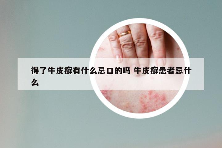 得了牛皮癣有什么忌口的吗 牛皮癣患者忌什么