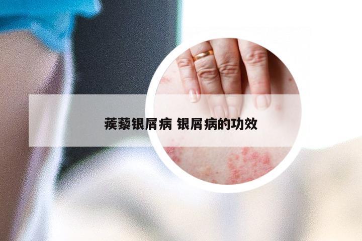 蒺藜银屑病 银屑病的功效