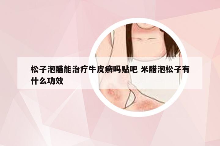 松子泡醋能治疗牛皮癣吗贴吧 米醋泡松子有什么功效