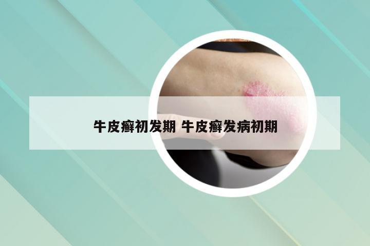 牛皮癣初发期 牛皮癣发病初期