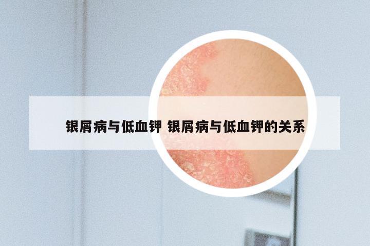 银屑病与低血钾 银屑病与低血钾的关系
