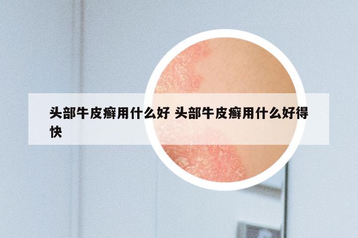 头部牛皮癣用什么好 头部牛皮癣用什么好得快