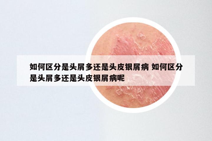 如何区分是头屑多还是头皮银屑病 如何区分是头屑多还是头皮银屑病呢