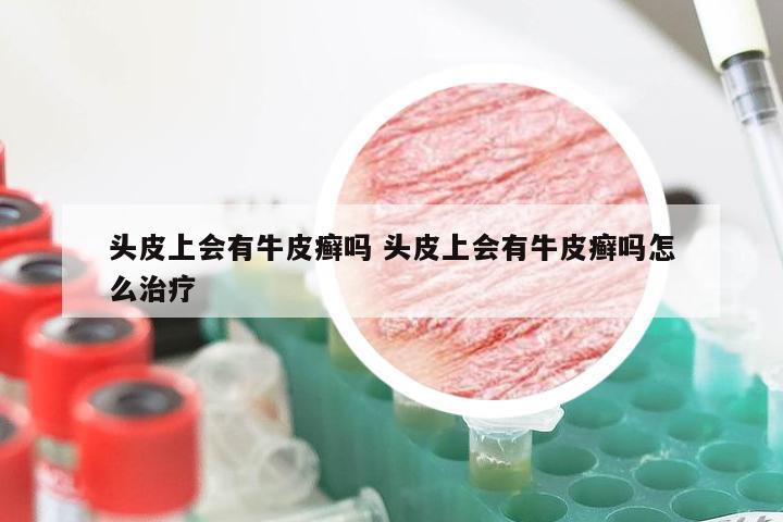 头皮上会有牛皮癣吗 头皮上会有牛皮癣吗怎么治疗