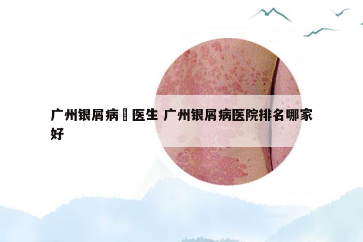 广州银屑病禤医生 广州银屑病医院排名哪家好