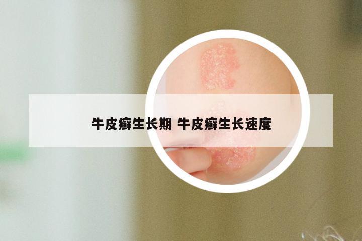 牛皮癣生长期 牛皮癣生长速度