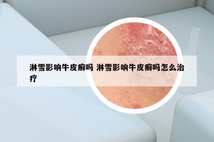 淋雪影响牛皮癣吗 淋雪影响牛皮癣吗怎么治疗