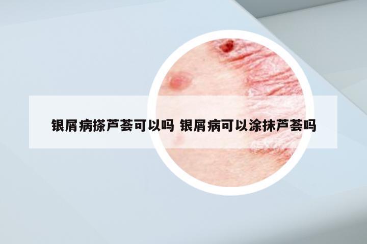 银屑病搽芦荟可以吗 银屑病可以涂抹芦荟吗
