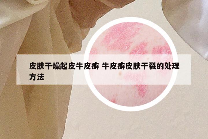 皮肤干燥起皮牛皮癣 牛皮癣皮肤干裂的处理方法