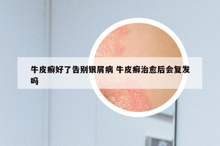 牛皮癣好了告别银屑病 牛皮癣治愈后会复发吗
