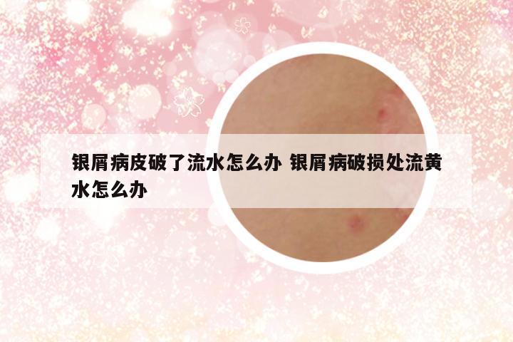 银屑病皮破了流水怎么办 银屑病破损处流黄水怎么办